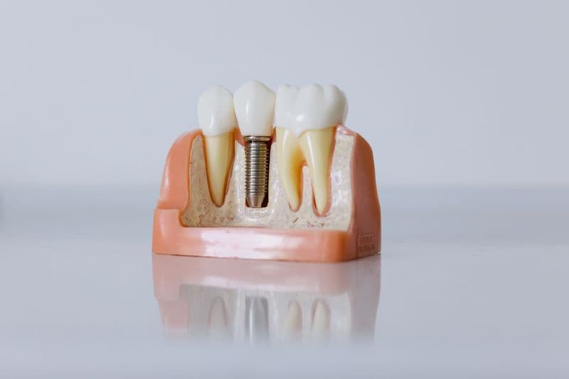 Dental implant model showing tooth replacement structure